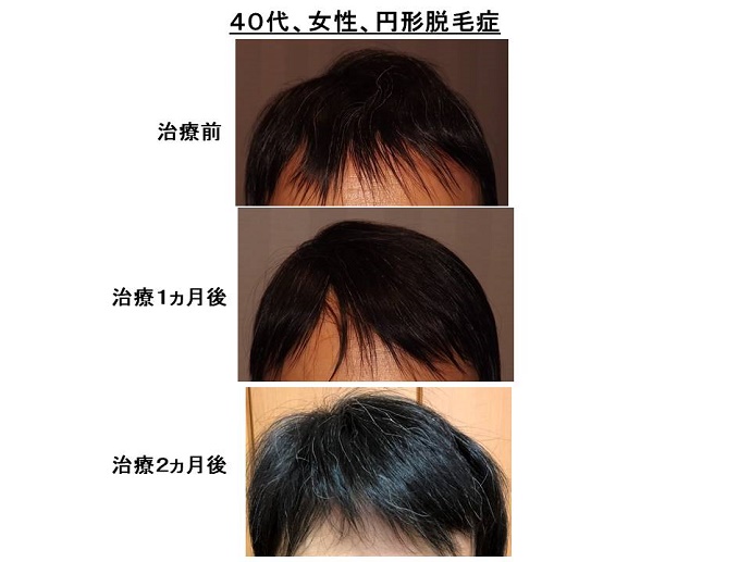 円形脱毛症　病院""